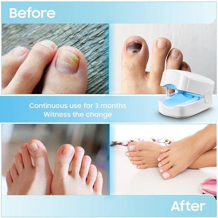 Portable Nail Fungus Laser Device with Rechargeable Battery and One-Button Operation